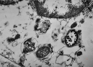 F,49y. | purulent meningitis- meningococcal v.s. F,49y. | purulent meningitis- meningococcal v.s.